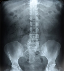 radiograph of the pelvis