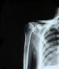 X-ray of shoulder joint