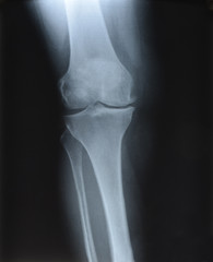 X-ray picture showing knee joints