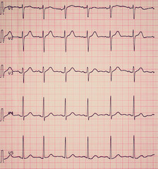 Electrocardiography of heart beat