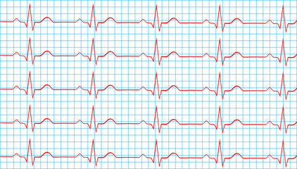 Naklejka premium Heart Normal Sinus Rhythm On Electrocardiogram Record