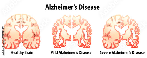alzhiemiers disease hca 240 Hca 240 week 2 assignment infectious disease essay sexually transmitted disease that has affected many people and altered many lives and a disease that i hope one. alzhiemiers disease hca 240 Hca 240 week 2 assignment infectious disease essay sexually transmitted disease that has affected many people and altered many lives and a disease that i hope one.