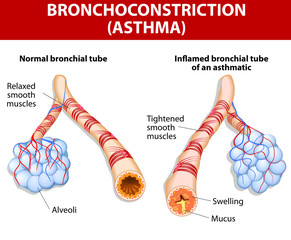 inflamation of the bronchus causing asthma - obrazy, fototapety, plakaty