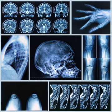 Radiography of Human Bones