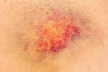Fototapeta premium Nasty looking bruise on hip, macro shot