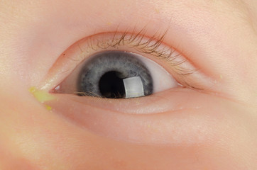 Pink eye (Conjunctivitis)