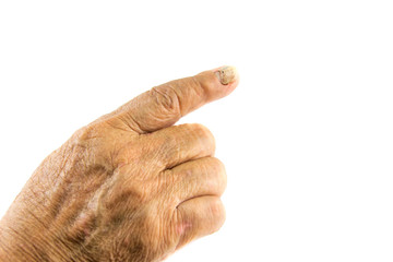 nail detachment  of old woman's finger