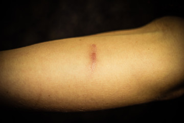 Woman's forearm with scar from self harm