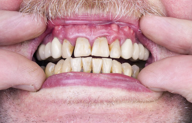 Problems with the teeth and gums