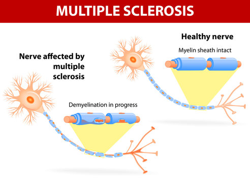 Nerve Affected By Multiple Sclerosis