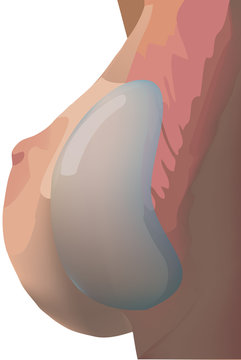 protesi del seno