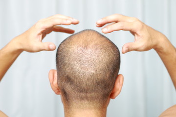 Obraz premium 薄毛の男性