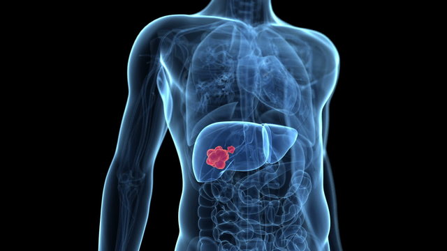 liver cancer