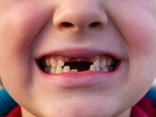 Mouth of child with Changing Teeth