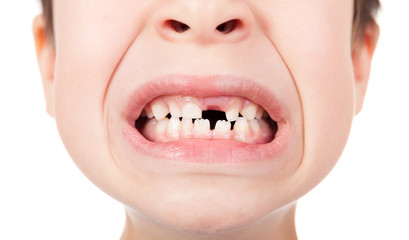 Fototapeta premium Boy portrait with a lost tooth