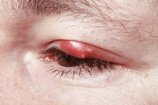 Chalazion and Blepharitis. Sore Red Eye. Sickness