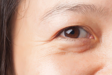 Wrinkles under eye