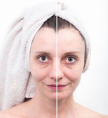 Woman with spotty skin with deep pores and blackhead and healed