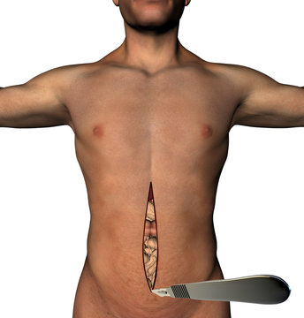 Chirurgia tradizionale addome taglio bisturi corpo umano