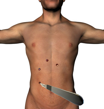 Laparoscopia chirurgia addome taglio buchi bisturi corpo umano