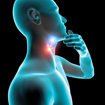 Mal di gola infiammazione arrossamento dolore, pastiglia e cura