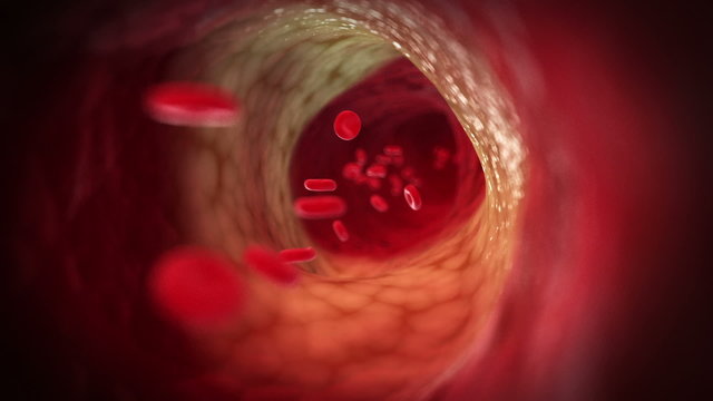 Medical animation - arteriosclerosis