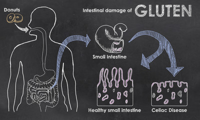 Intestinal Damage of Gluten - obrazy, fototapety, plakaty