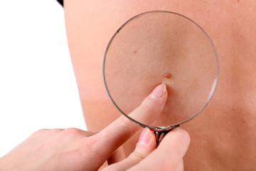 Fototapeta premium Dermatologist examines a birthmark of patient, close up