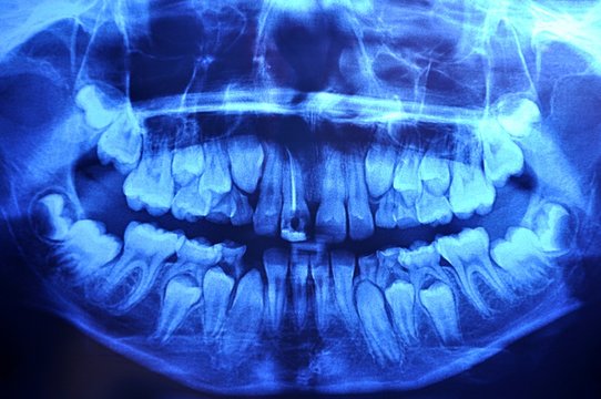 12-year old boy panoramic dental x-ray