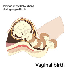 Vaginal birth