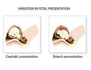 Variation in  fetal presentation.  Pregnancy