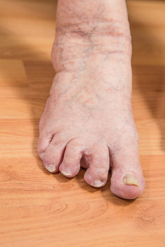 damaged toes of a senior person