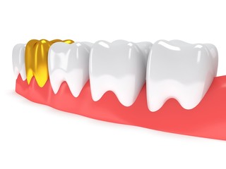 Obraz premium Teeth on gingiva isolated on white back.