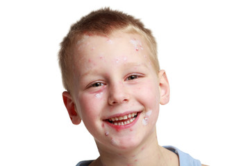 Little boy with chickenpox