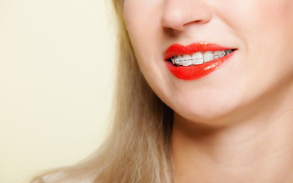 Part of female face. Smile. Teeth straighten, tooth hygiene