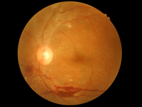 retinal of diabatic retinophaty