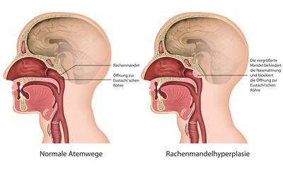 Rachenmandelhyperplasie, adenoide verformung deutsch - obrazy, fototapety, plakaty