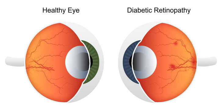 Comparison of health eye vs eye affected by diabetic retinopathy