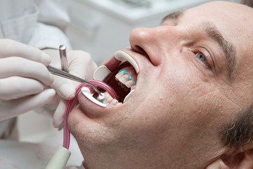 Man during teeth whitening process at the dentist office