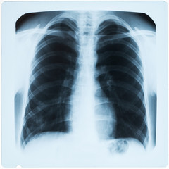 X-ray of man's chest during pneumonia - obrazy, fototapety, plakaty