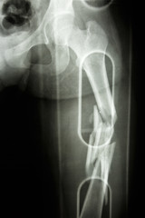 fracture shaft of femur