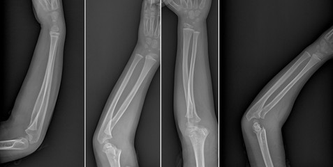 Broken arm xray