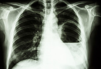 lung abscess