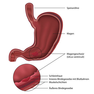 Magengeschw&uuml;r (Ulcus ventriculi) mit Erkl&auml;rung, deutsch