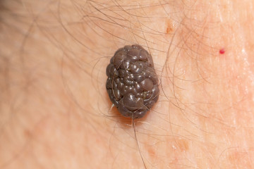 a mole on the skin. macro