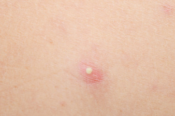 pimple