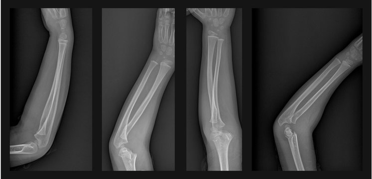 Broken Arm Xray