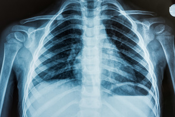 X-Ray Of A Child Torso Showcasing The Ribcage, Spine, And Both Upper Arms, Illustrating The Intricate Structure Of The Human Skeletal System