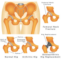 Hip joint. Arthritic Hip. Hip fracture