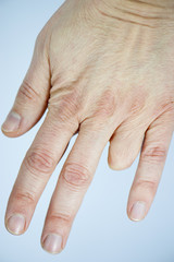 Amputated finger